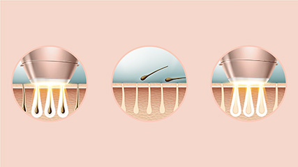 Erklärbild Philips Lumea Advanced