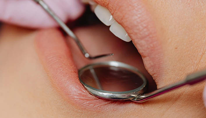 Offener Mund, in welchem sich das Werkzeug eines Zahnarztes befindet