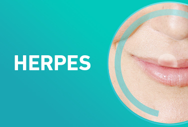 drogerie-markenwelt-3er-kombi-compeed-herpes-376x255-87304-0