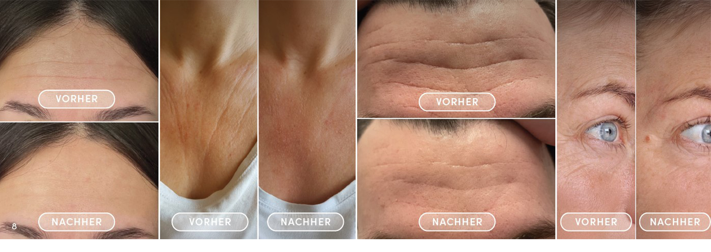 apricot-vorher-nachher effekt